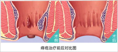 得了痔疮怎么办
