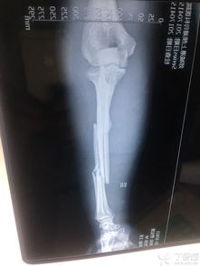 尺桡开放骨折